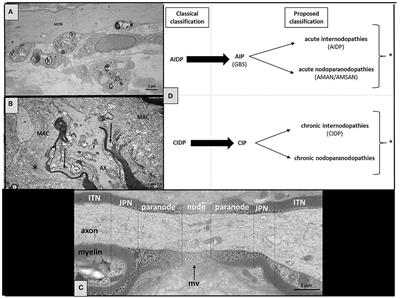 Chronic Inflammatory or Chronic Inflammatory Demyelinating Polyradiculoneuropathy?